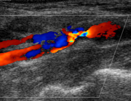  Ultraschallbild einer hochgradigen Karotis Stenose
